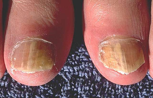 Best Home Remedies for Nail Fungus Treatment