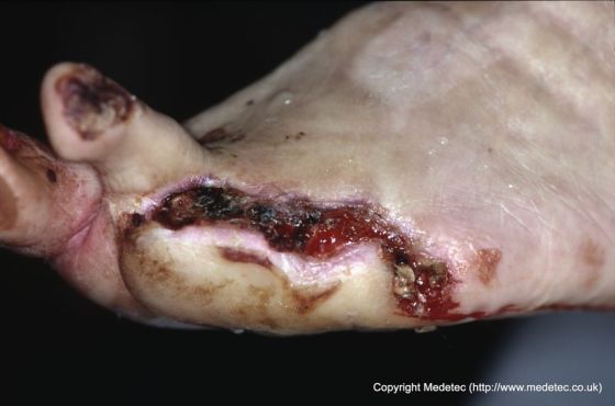 Best Practices for Preventing Diabetic Foot Ulcers