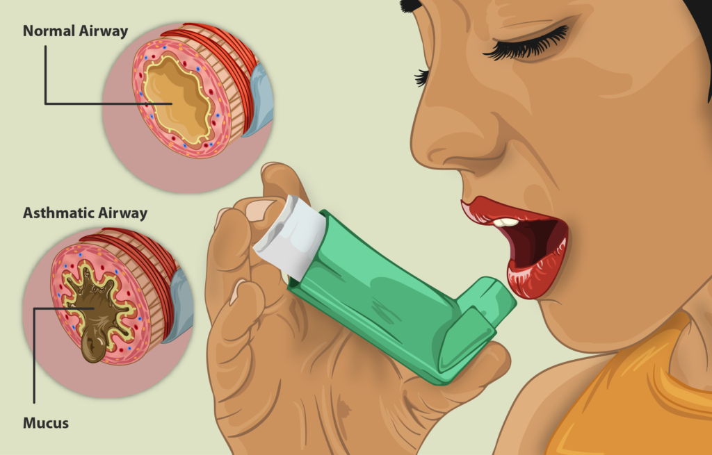 Common Questions About Asthma