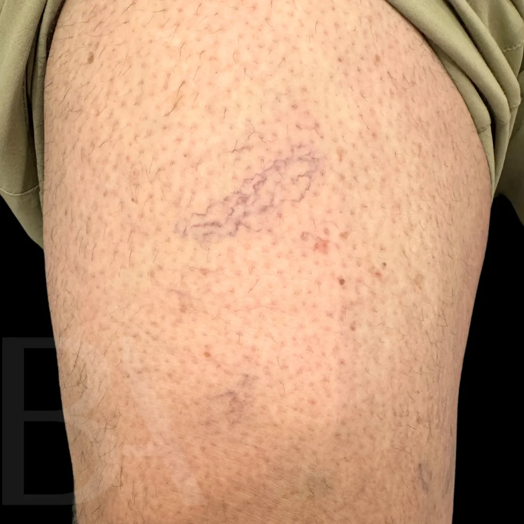 FAQs About Varicose Veins