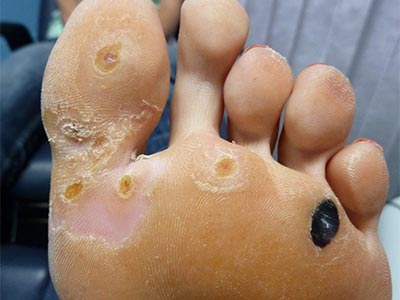 FAQs About Wart Removal