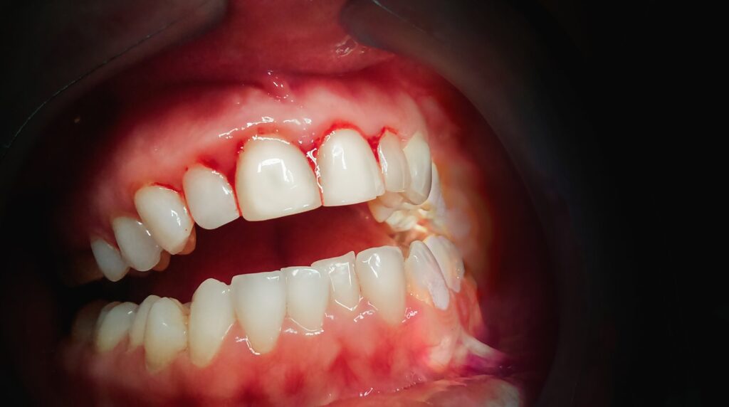 How Dentists Treat Common Issues Like Cavities and Gum Disease