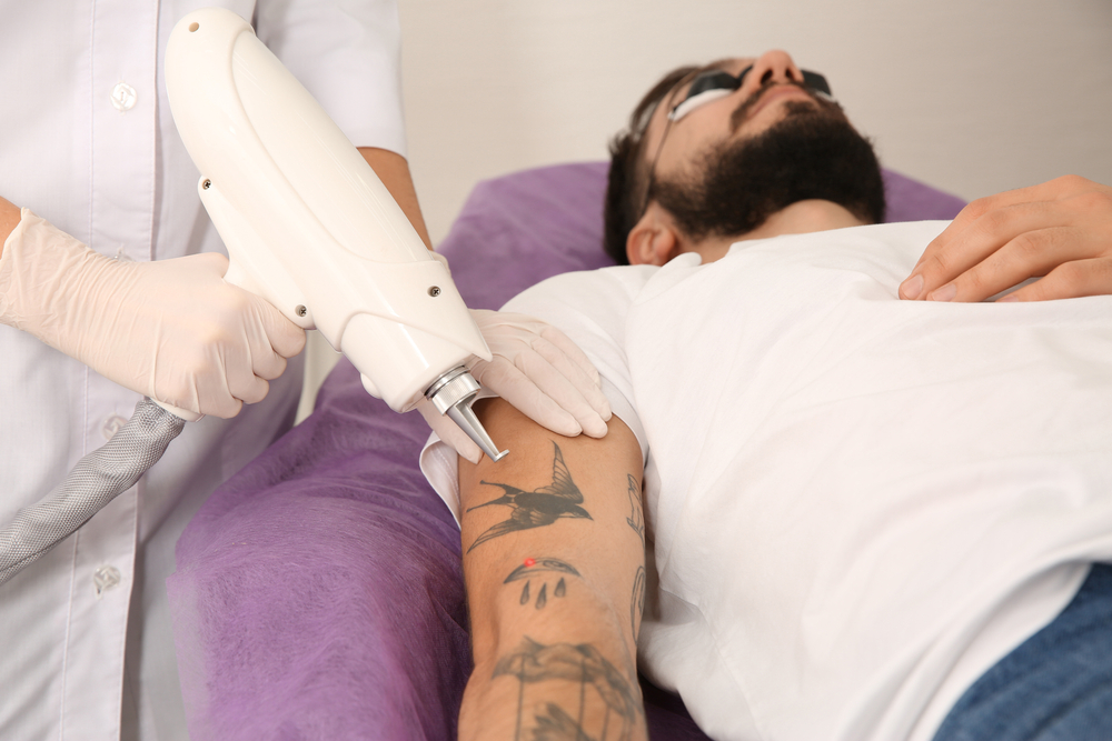 How Does Tattoo Removal Work