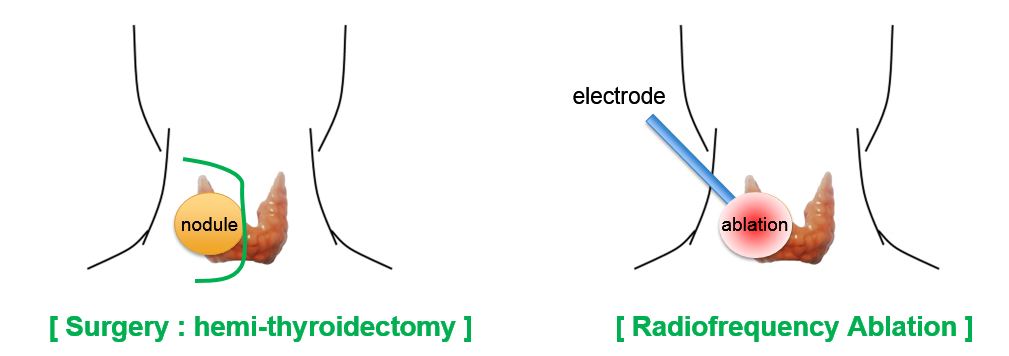How To Prepare for a Thyroid Radiofrequency Ablation Procedure