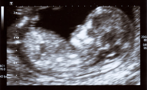 How Ultrasound Helps Detect Common Gynecologic Conditions