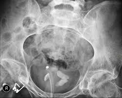 How Vasectomy Reversal Works and When It's an Option