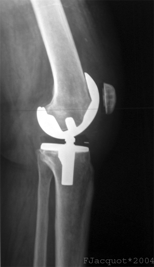 How to Know When It’s Time for Total Joint Replacement