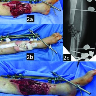 Innovative Wound Care Solutions for Non-Healing Foot Wounds
