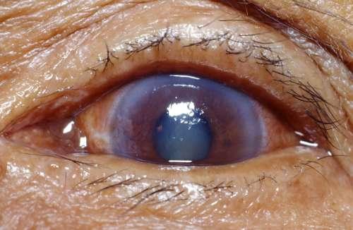 Lifestyle Changes to Help Manage Glaucoma