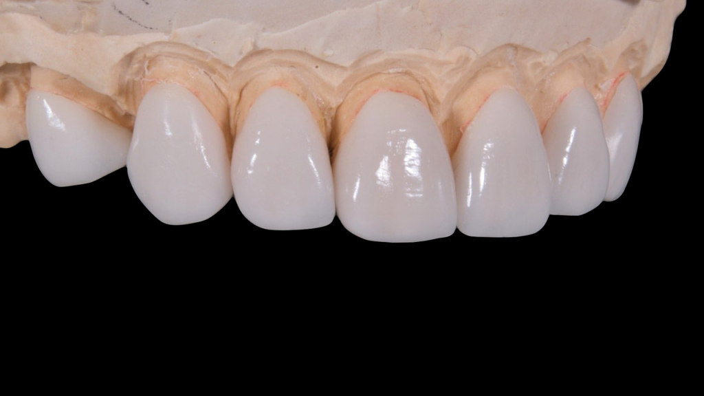 Porcelain vs. Metal Crowns