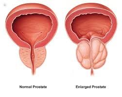 The Importance of Urologists in Treating Prostate Cancer Early