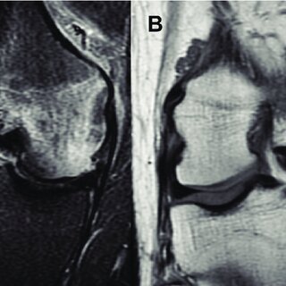 The Role of Physical Therapy in Meniscectomy Recovery