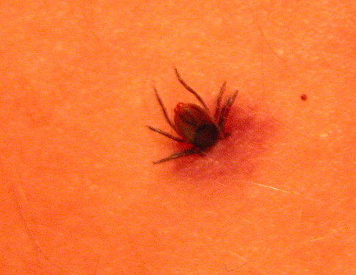 Understanding Post-Treatment Lyme Disease Syndrome