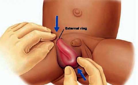 Understanding the Different Types of Hernias and How They Affect the Body