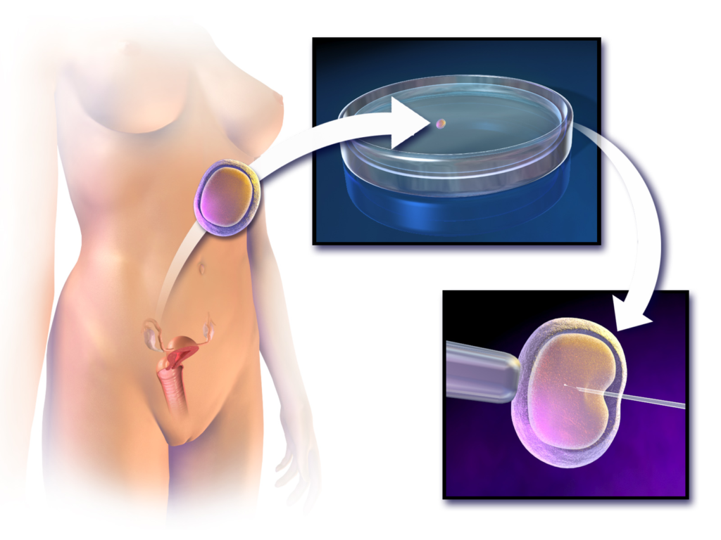 What Is the Timeline for In Vitro Fertilization?