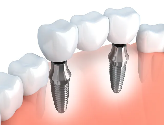 What To Know About Dental Implants