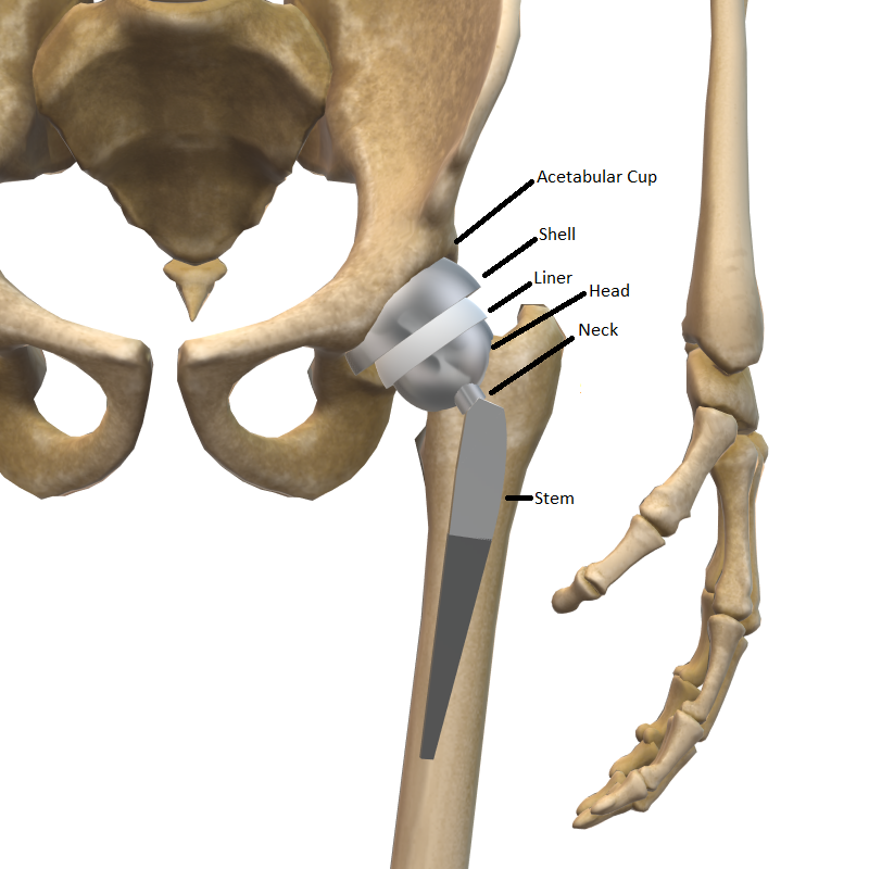 What to Expect Before, During, and After Hip Replacement Surgery