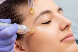 Why Microneedling is the Go-To Treatment for Glowing Skin