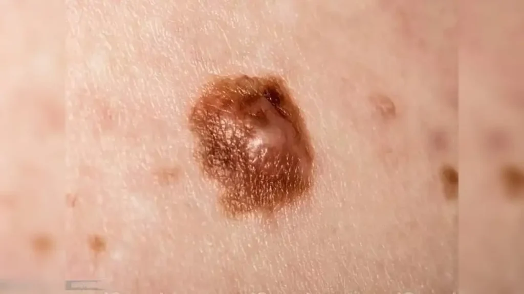 Recognizing the Signs and Symptoms of Skin Cancer
