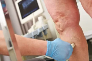 Understanding the Causes and Treatments for Varicose Veins