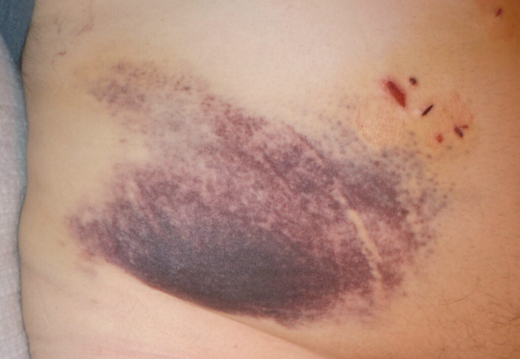 What To Expect From Gallbladder Removal Surgery