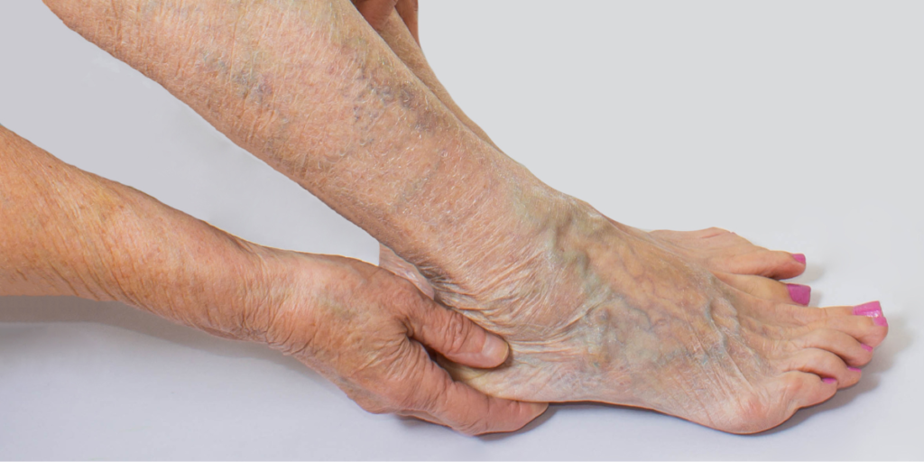How Varicose Veins Affect Your Daily Life and Wellbeing