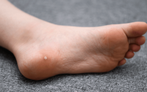 How to Effectively Treat Warts on the Feet